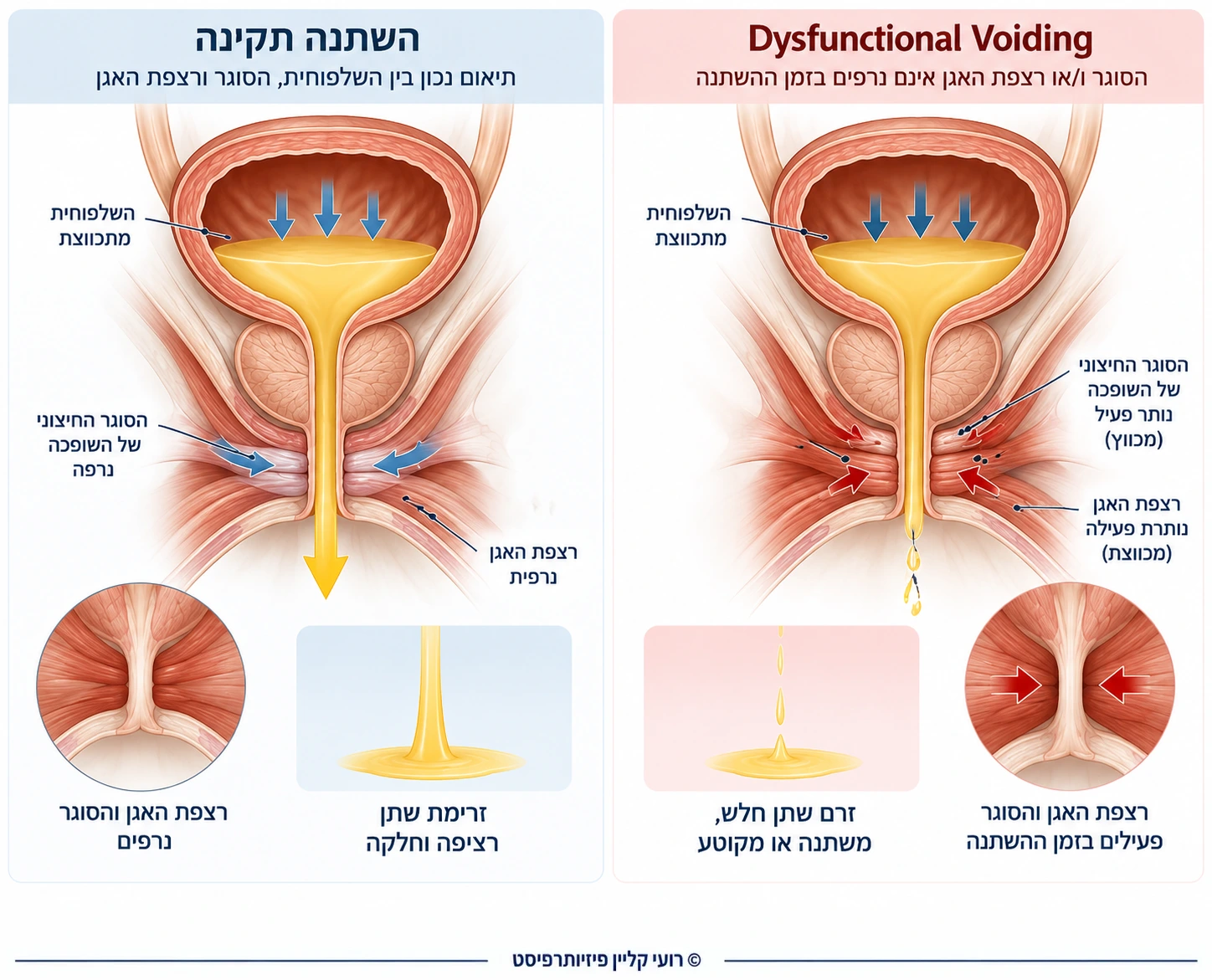 השוואה בין השתנה תקינה, שבה הסוגר ורצפת האגן נרפים בזמן שהשלפוחית מתכווצת, לבין Dysfunctional Voiding, שבו ההרפיה אינה מתרחשת ונוצרת התנגדות לזרימת השתן
